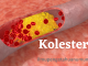 Mengenal Kolesterol dan Cara mengatasi kolesterol