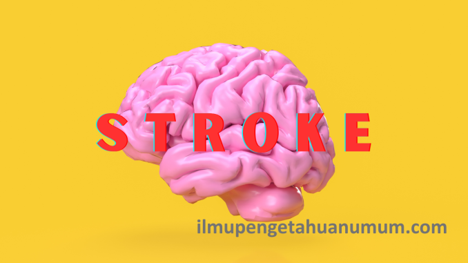 pengertian stroke dan gejala stroke serta cara mencegah stroke